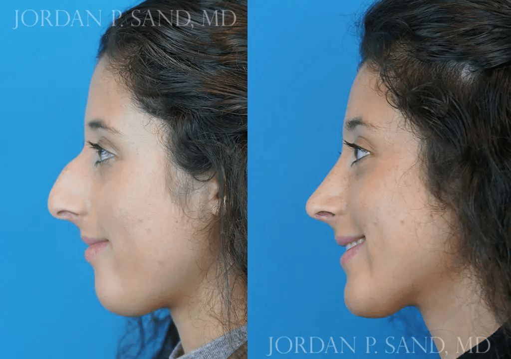 Rhinoplasty 5