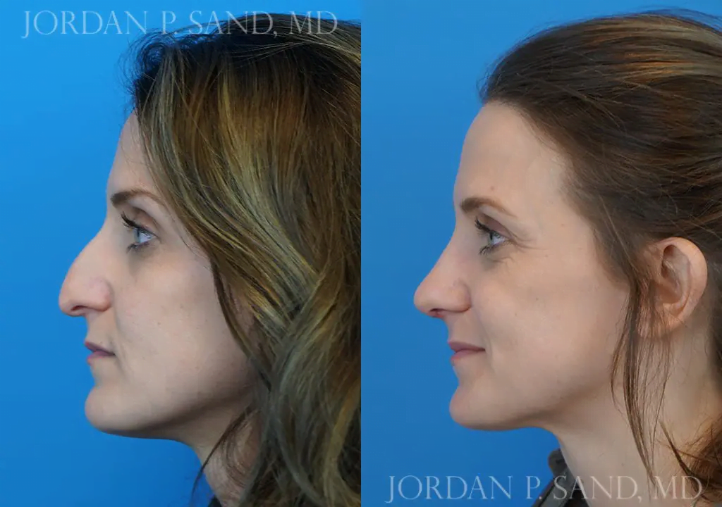 Rhinoplasty 10