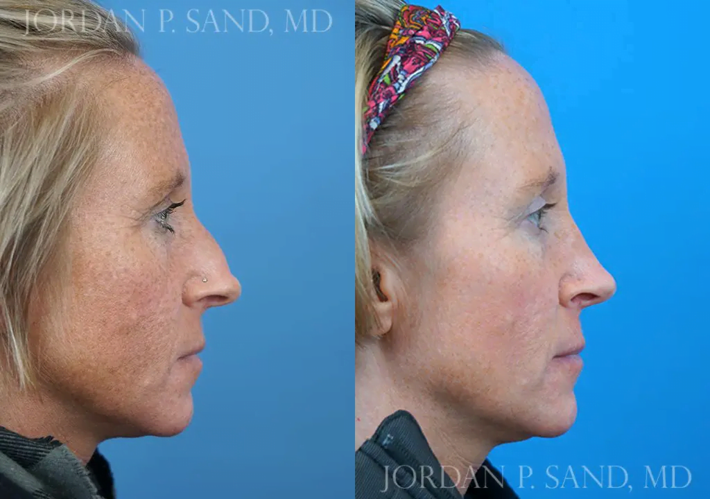 Rhinoplasty 13