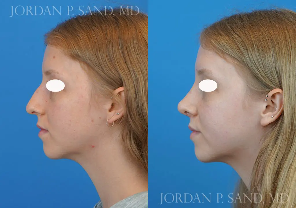 Rhinoplasty 14