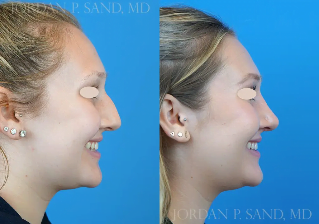 Rhinoplasty 15