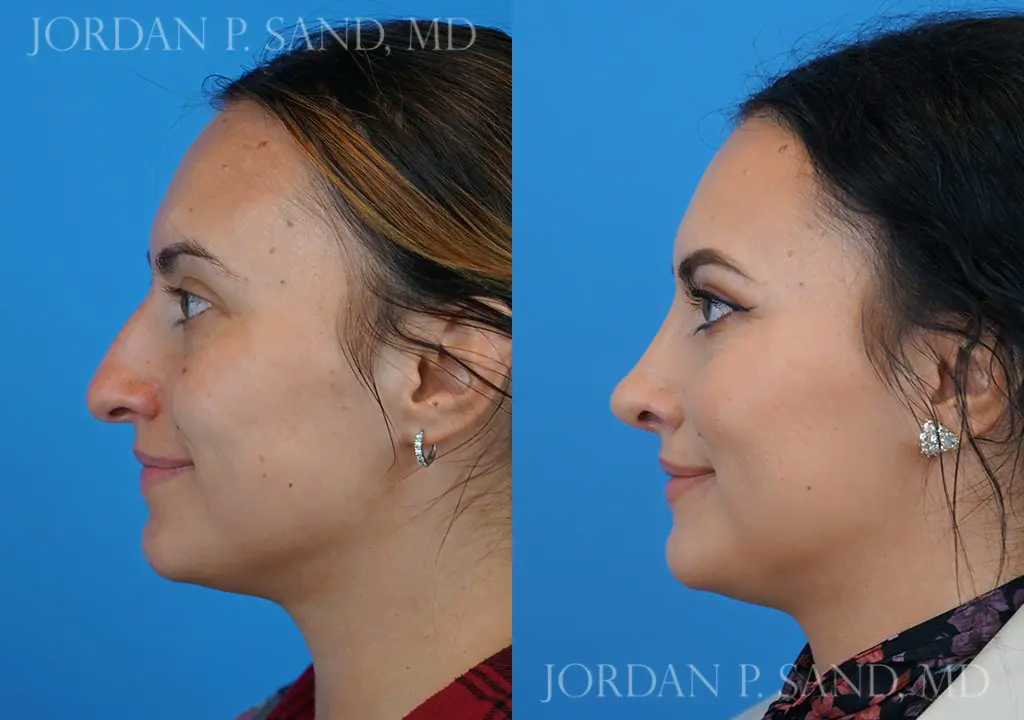 Rhinoplasty 16