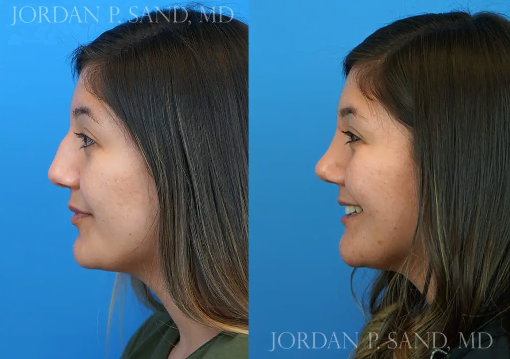 Rhinoplasty 17