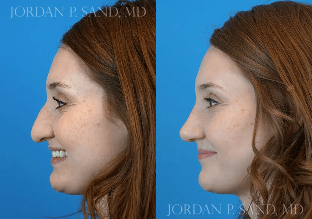 Rhinoplasty 12