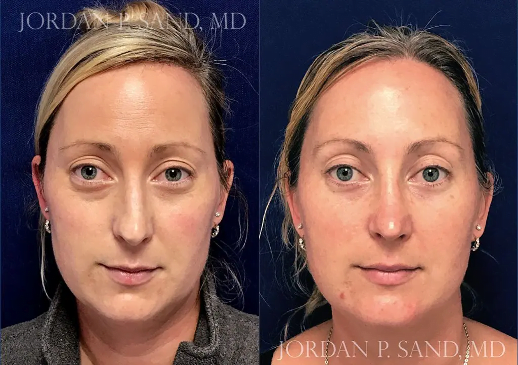 Revision Rhinoplasty 1