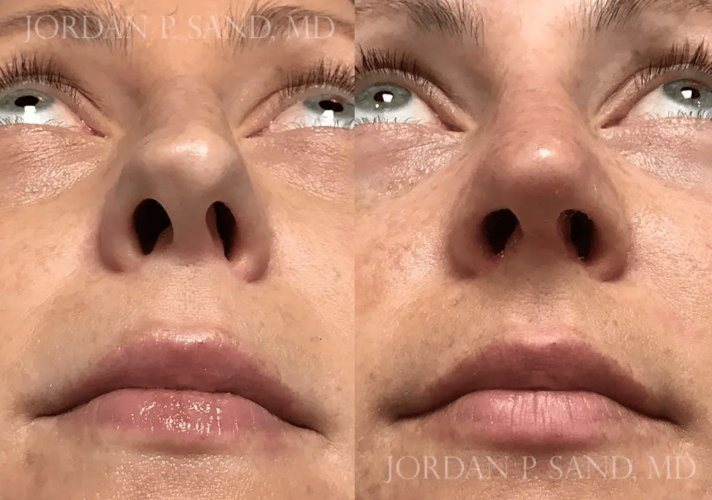 Revision Rhinoplasty 1