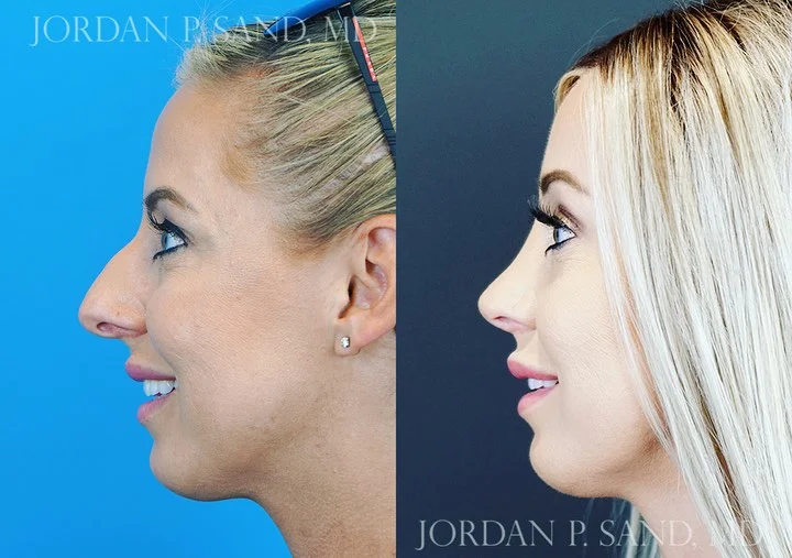 Rhinoplasty 73