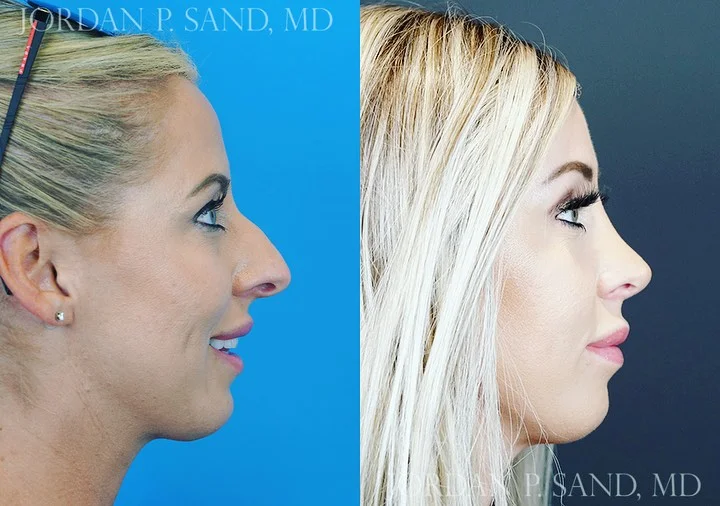 Rhinoplasty 73