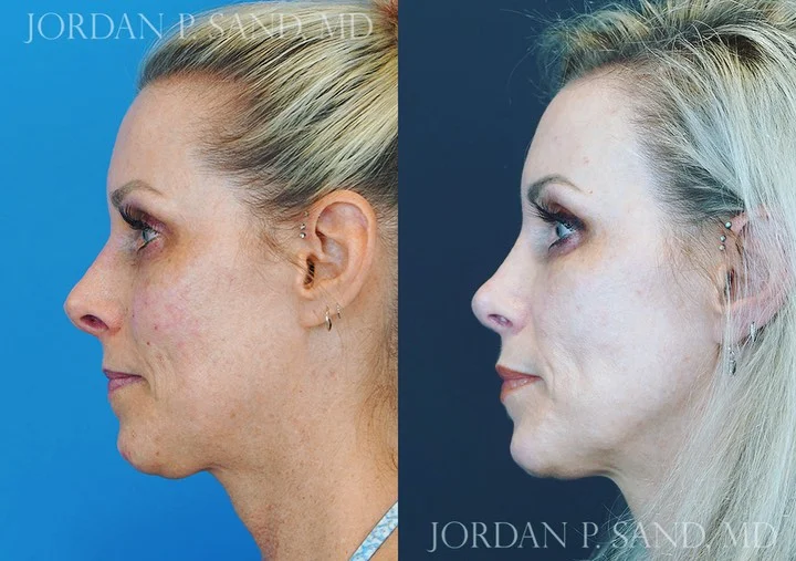 Revision Rhinoplasty 5