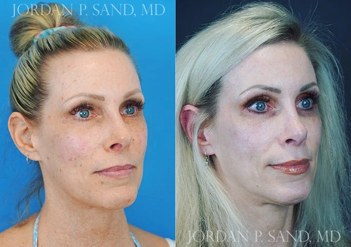 Revision Rhinoplasty 5