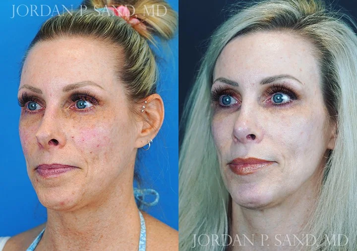 Revision Rhinoplasty 5