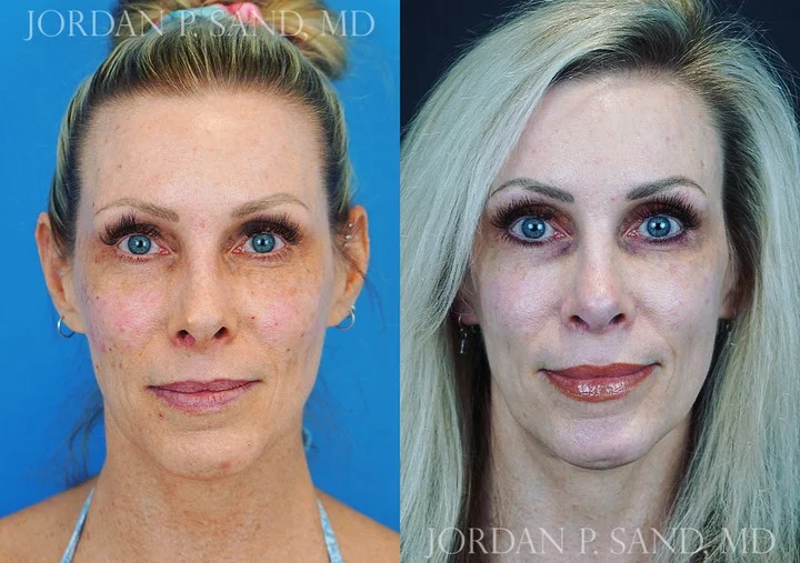 Revision Rhinoplasty 5