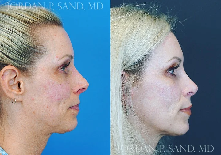 Revision Rhinoplasty 5