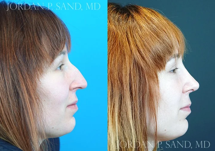 Rhinoplasty 76