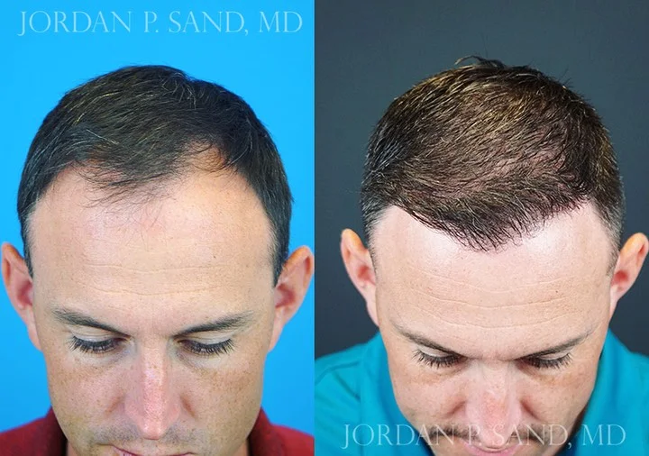 Hair Transplant 7