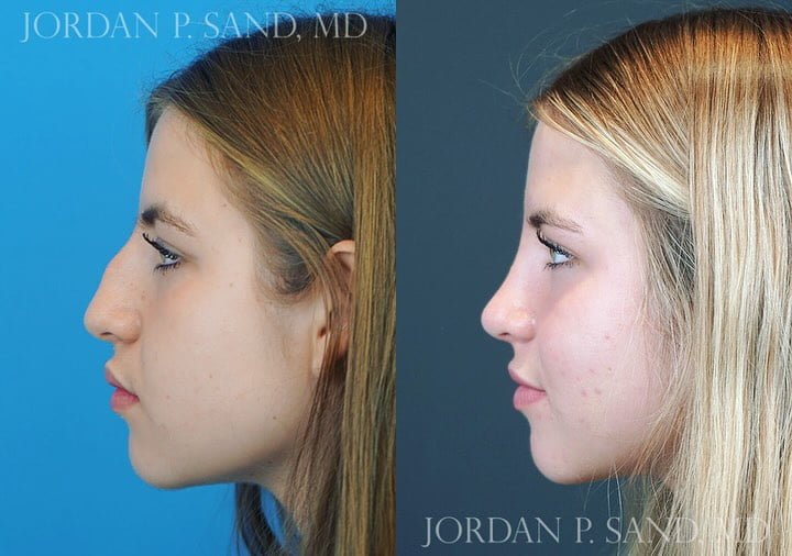 Rhinoplasty 77