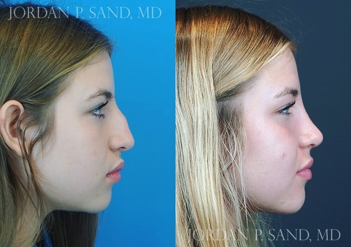 Rhinoplasty 77
