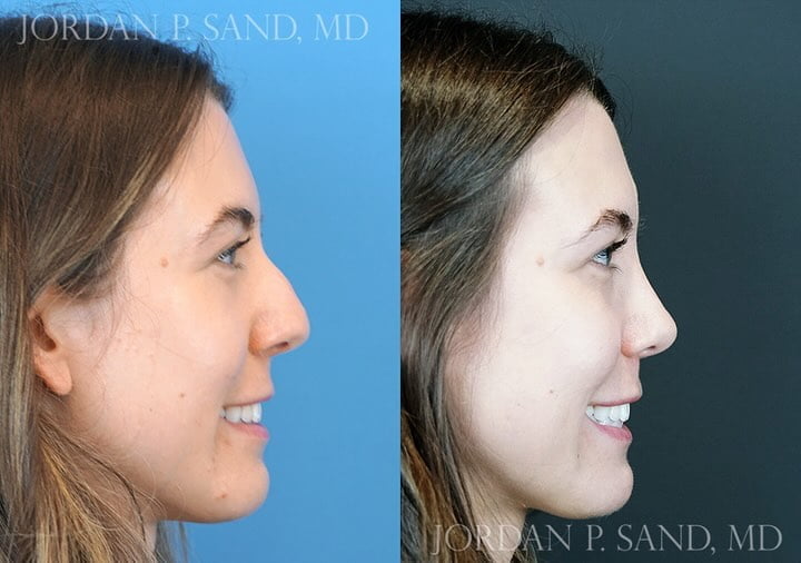 Rhinoplasty 78