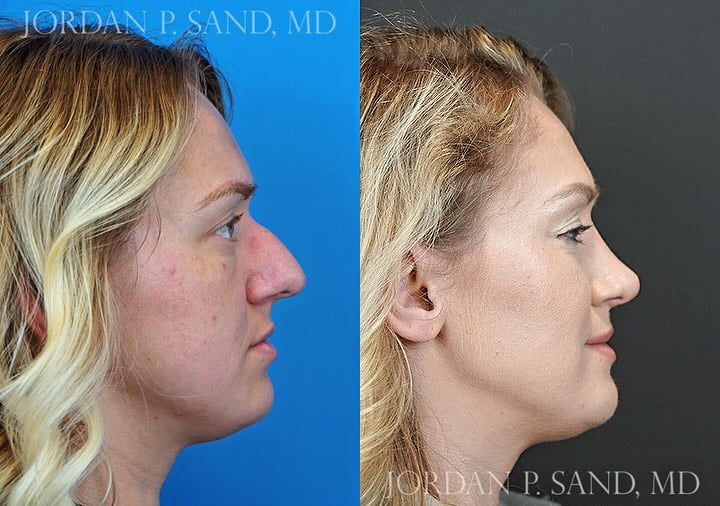 Rhinoplasty 79