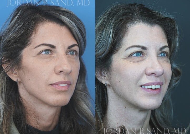 Revision Rhinoplasty 4