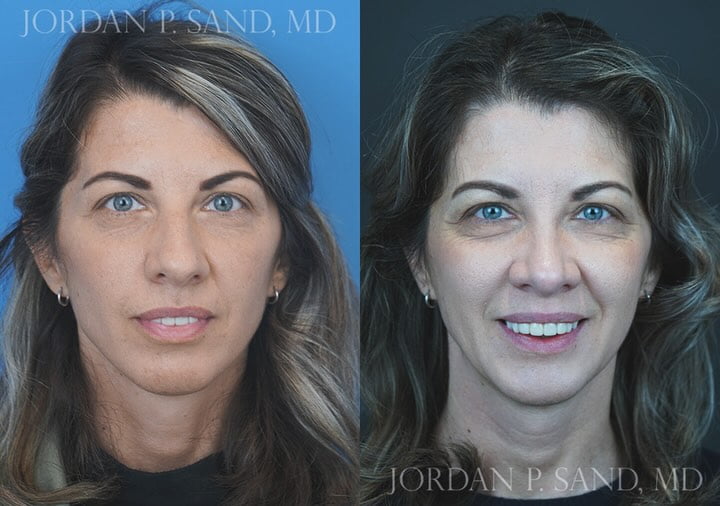 Revision Rhinoplasty 4