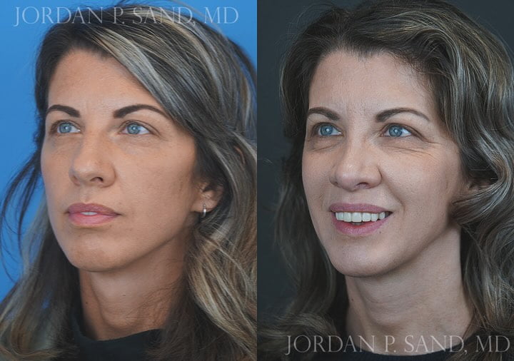 Revision Rhinoplasty 4