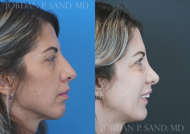 Revision Rhinoplasty 4