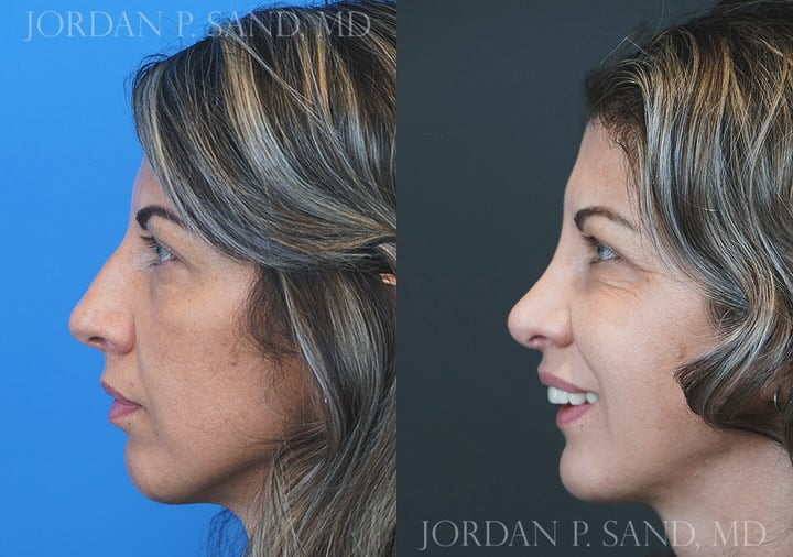 Revision Rhinoplasty 4