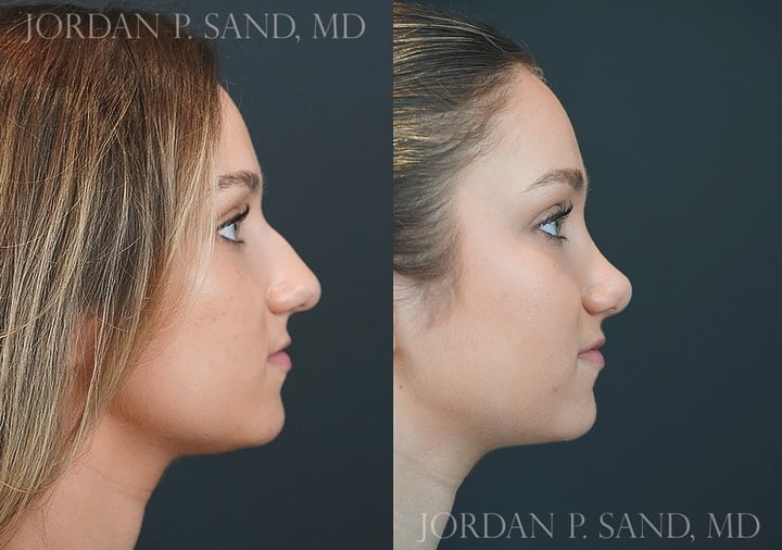 Rhinoplasty 82