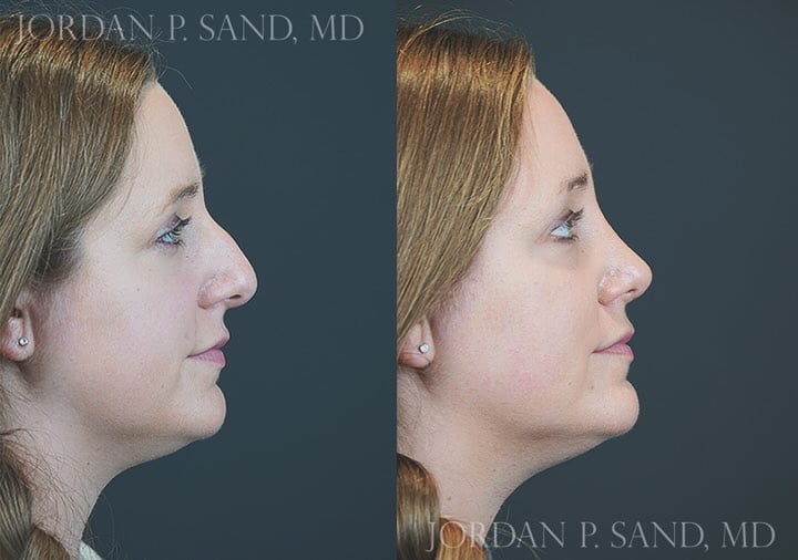 Rhinoplasty 85
