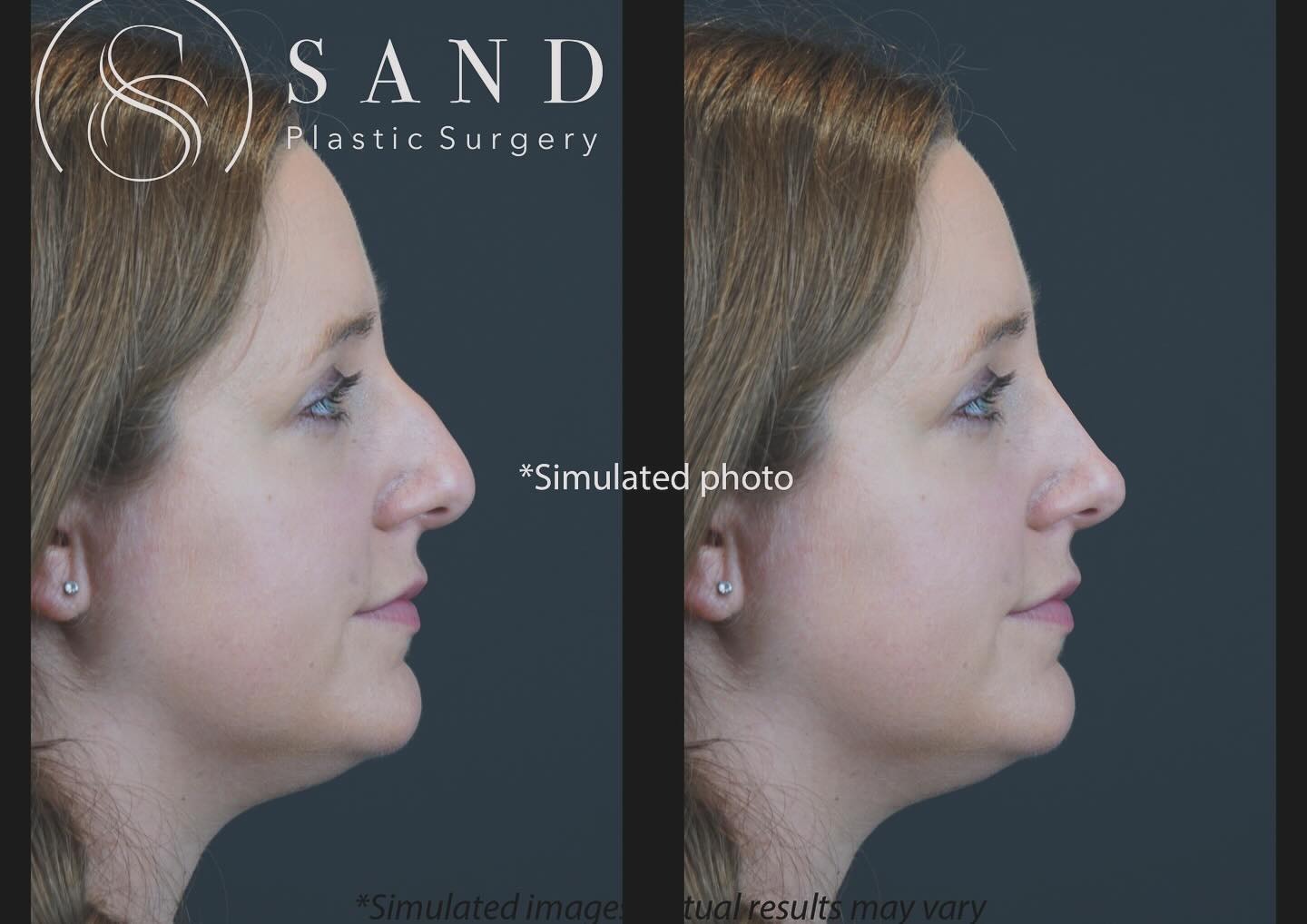 Rhinoplasty 85