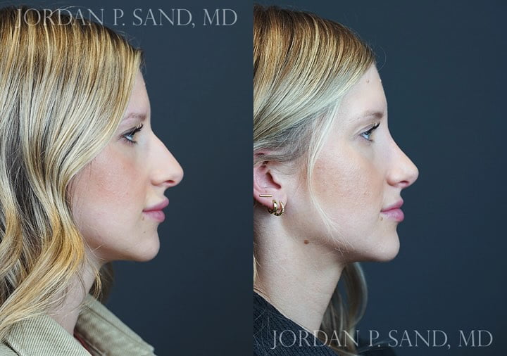 Rhinoplasty 86