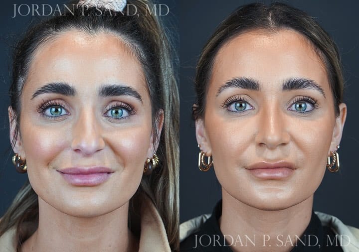 Rhinoplasty 90