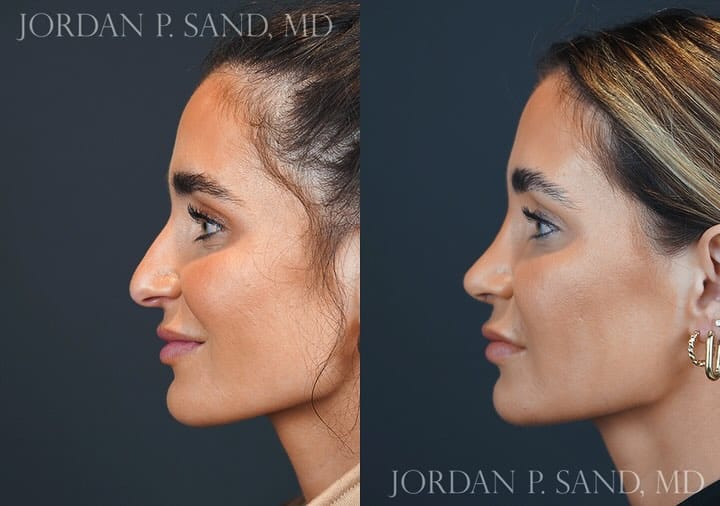 Rhinoplasty 90