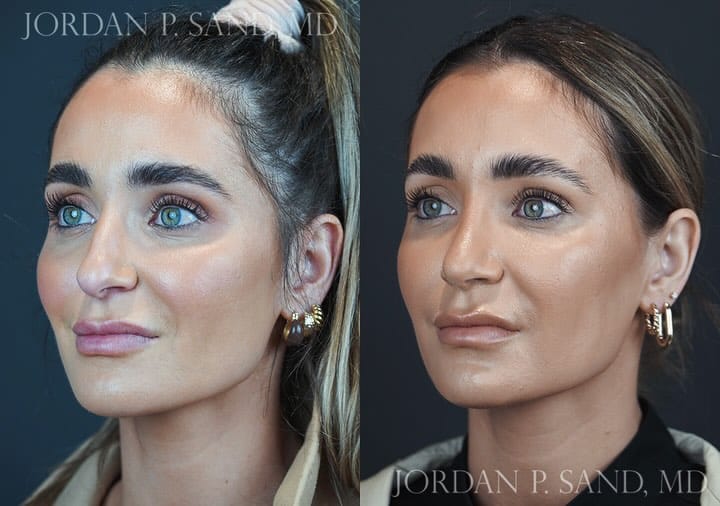 Rhinoplasty 90