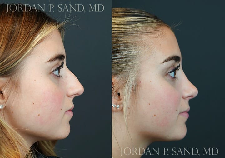 Rhinoplasty 91