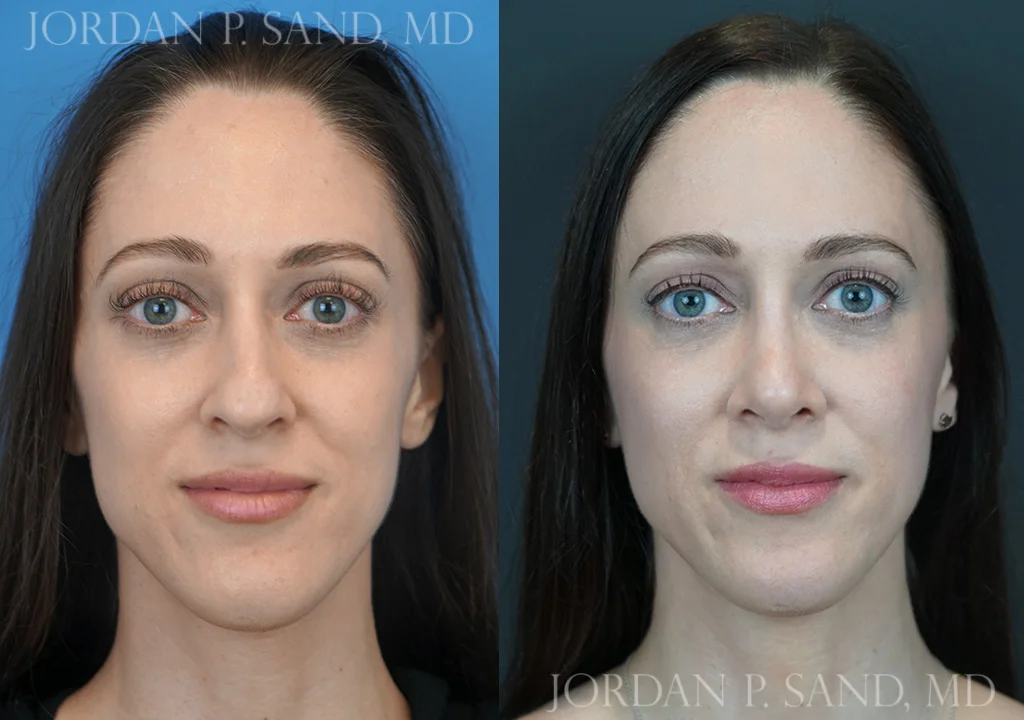 Rhinoplasty 75