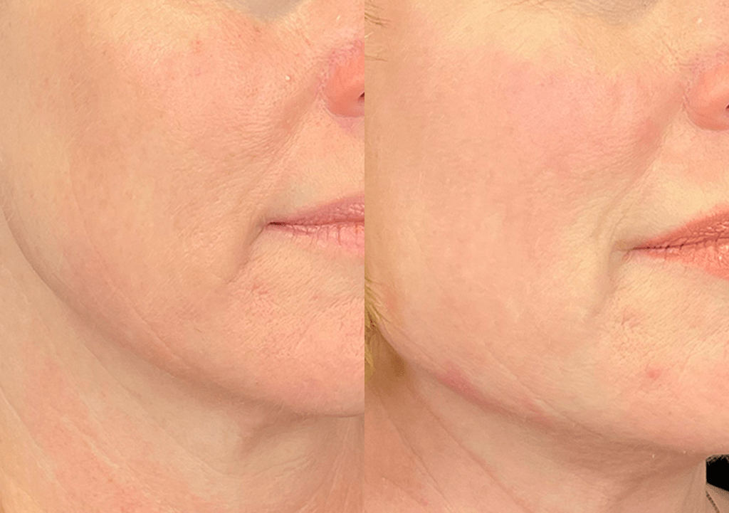 Mini Resurfacing Laser 1