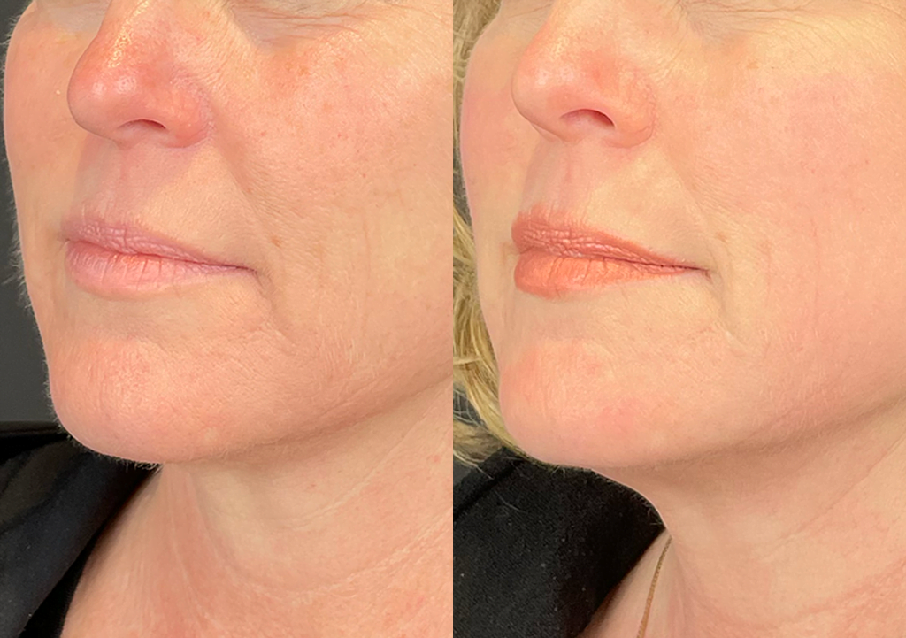 Mini Resurfacing Laser 1