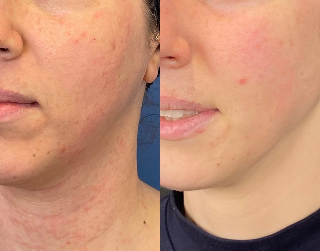 Microneedling 1