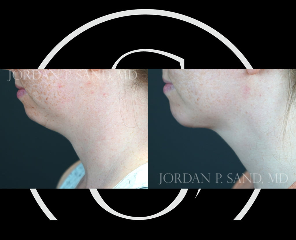 Chin Implant and FaceTite