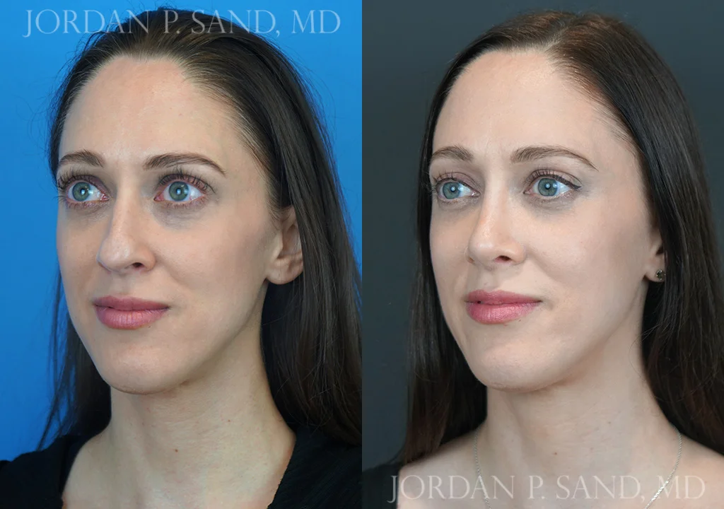Rhinoplasty 75