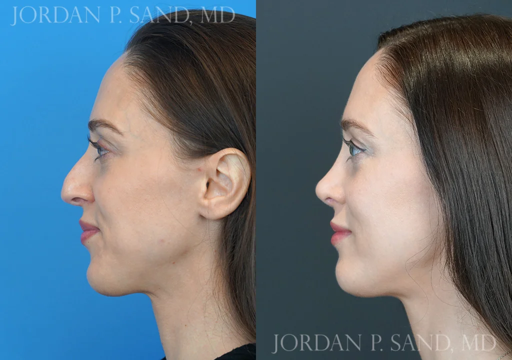 Rhinoplasty 75