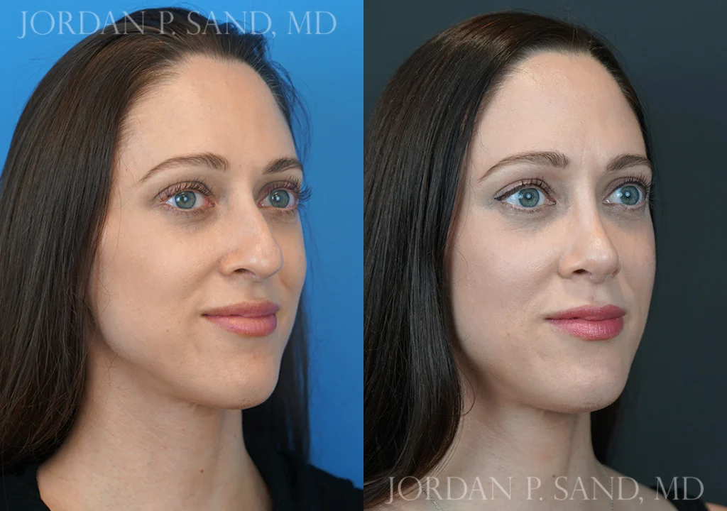 Rhinoplasty 75