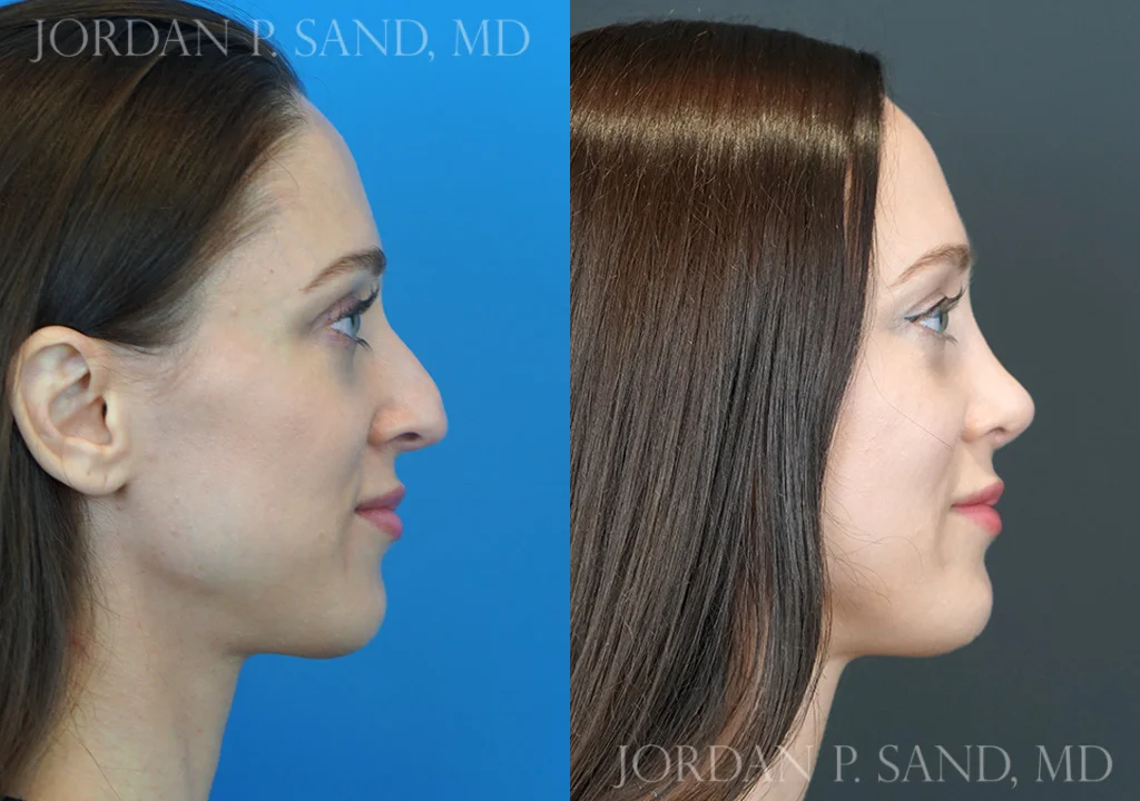 Rhinoplasty 75